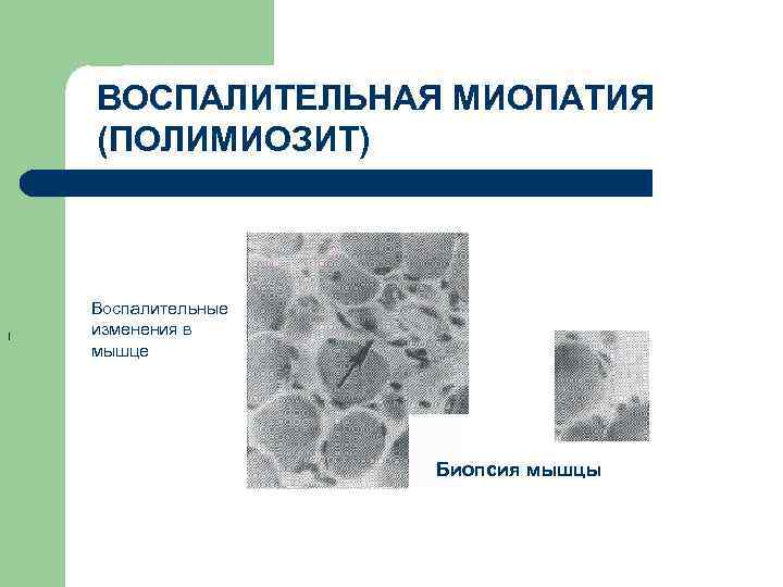 ВОСПАЛИТЕЛЬНАЯ МИОПАТИЯ (ПОЛИМИОЗИТ) I Воспалительные изменения в мышце Биопсия мышцы 