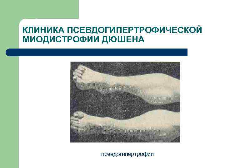КЛИНИКА ПСЕВДОГИПЕРТРОФИЧЕСКОЙ МИОДИСТРОФИИ ДЮШЕНА псевдогипертрофии 