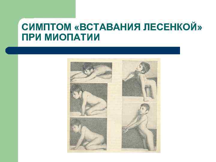 СИМПТОМ «ВСТАВАНИЯ ЛЕСЕНКОЙ» ПРИ МИОПАТИИ 