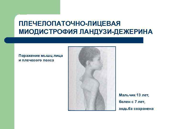 ПЛЕЧЕЛОПАТОЧНО-ЛИЦЕВАЯ МИОДИСТРОФИЯ ЛАНДУЗИ-ДЕЖЕРИНА Поражение мышц лица и плечевого пояса Мальчик 13 лет, болен с