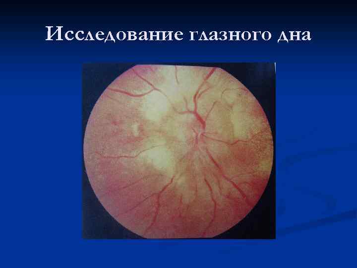 Исследование глазного дна 