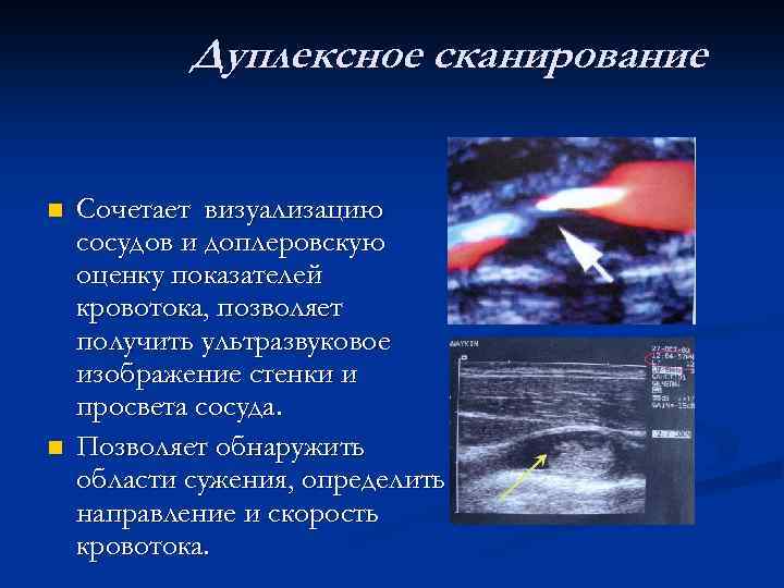 Дуплексное сканирование n n Сочетает визуализацию сосудов и доплеровскую оценку показателей кровотока, позволяет получить