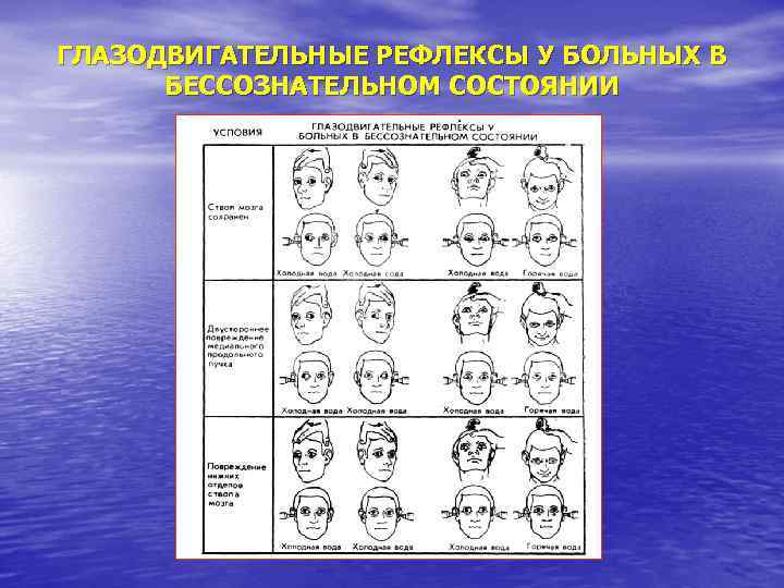 ГЛАЗОДВИГАТЕЛЬНЫЕ РЕФЛЕКСЫ У БОЛЬНЫХ В БЕССОЗНАТЕЛЬНОМ СОСТОЯНИИ 