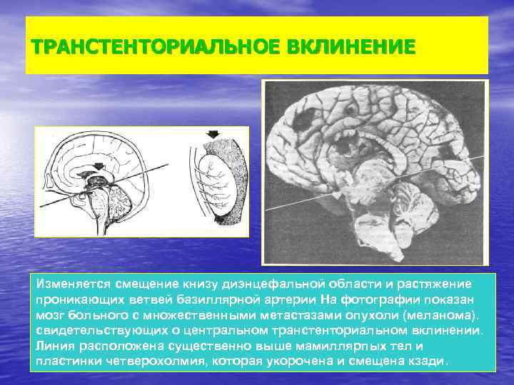 ТРАНСТЕНТОРИАЛЬНОЕ ВКЛИНЕНИЕ Изменяется смещение книзу диэнцефальной области и растяжение проникающих ветвей базиллярной артерии На