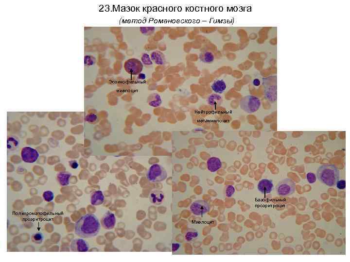 23. Мазок красного костного мозга (метод Романовского – Гимзы) Эозинофильный миелоцит Нейтрофильный метамиелоцит Базофильный