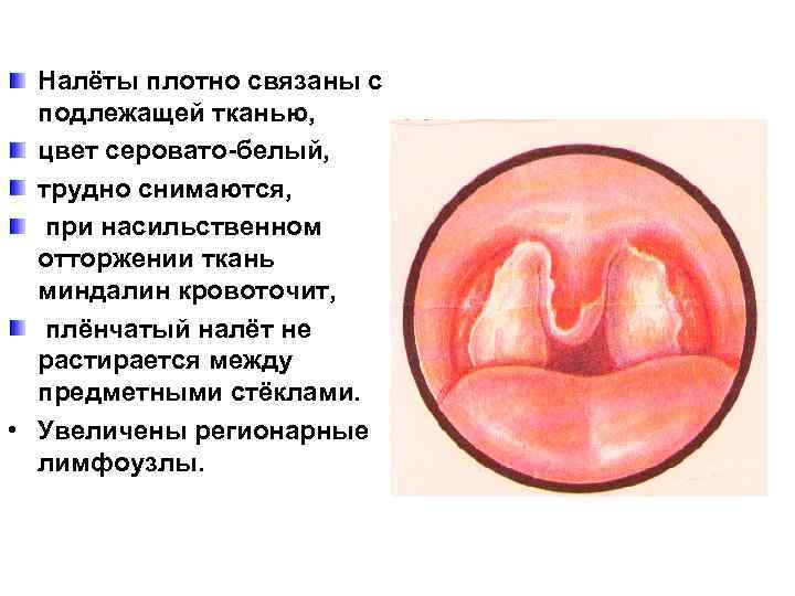 Налёты плотно связаны с подлежащей тканью, цвет серовато-белый, трудно снимаются, при насильственном отторжении ткань