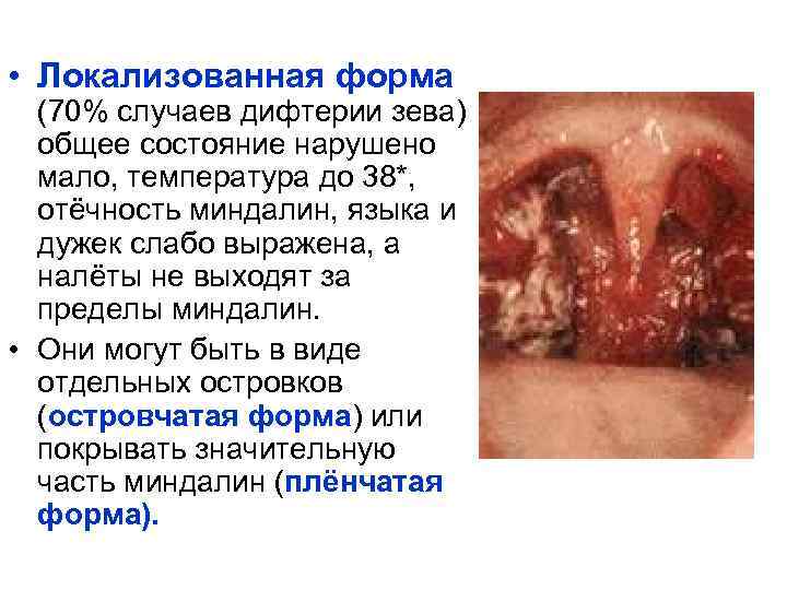  • Локализованная форма (70% случаев дифтерии зева) общее состояние нарушено мало, температура до