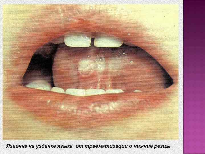   Длится 1 -3 недели.  Уменьшается частота и  тяжесть приступов, кашель