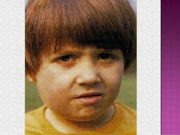  Возникает чаще всего через 3 – 6 дней от начала болезни. Проявляется подъемом