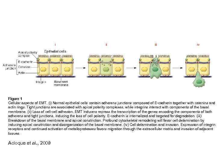 Figure 1 Cellular aspects of EMT. (i) Normal epithelial cells contain adherens junctions composed