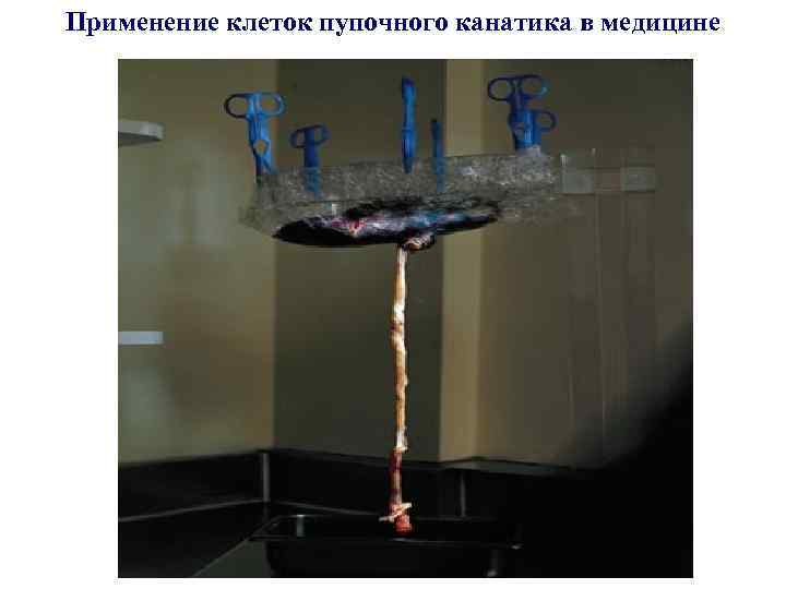 Применение клеток пупочного канатика в медицине 