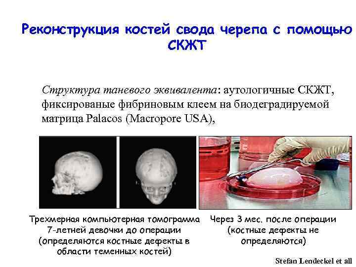 Реконструкция костей свода черепа с помощью СКЖТ Структура таневого эквивалента: аутологичные СКЖТ, фиксированые фибриновым