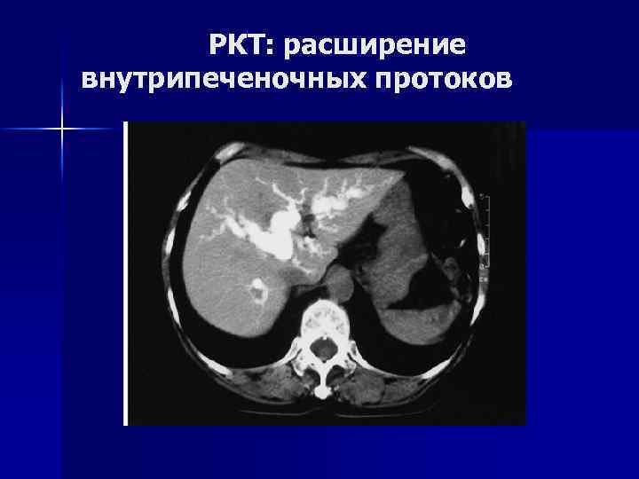 Уплотнение стенок млечных протоков