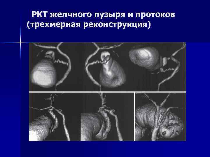 РКТ желчного пузыря и протоков (трехмерная реконструкция) 