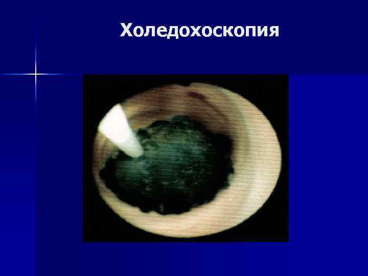 Холедохоскопия 