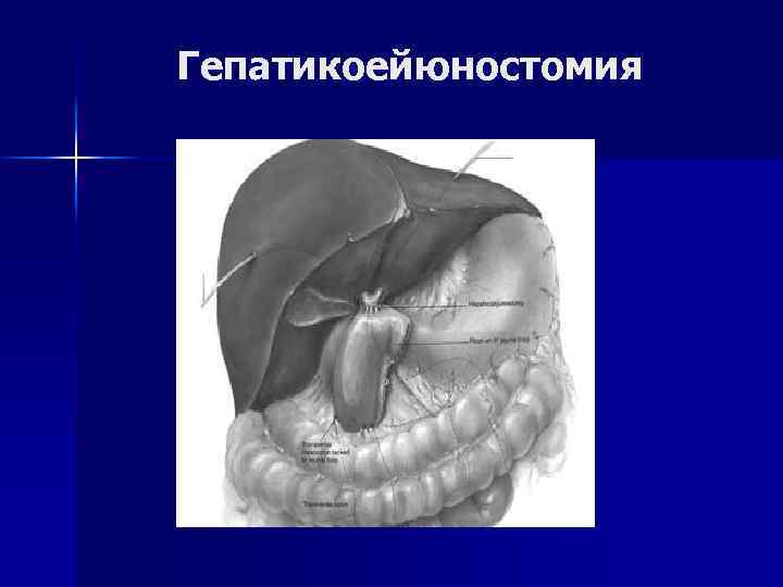 Гепатикоейюностомия 