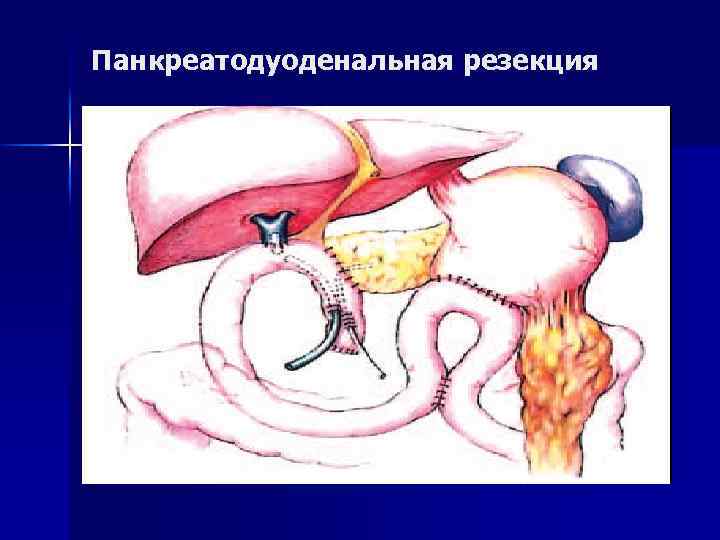 Механическая желтуха Этиология, патогенез, клиника, диагностика, методы ...