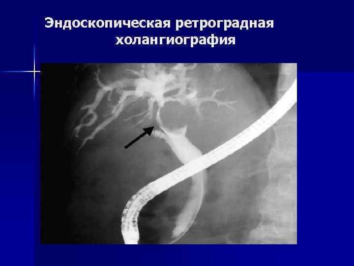 Эндоскопическая картина недостаточности кардии