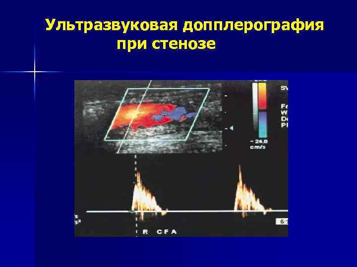 Ультразвуковая допплерография при стенозе 