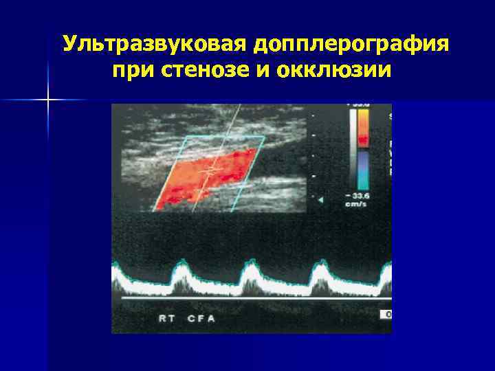 Ультразвуковая допплерография при стенозе и окклюзии 