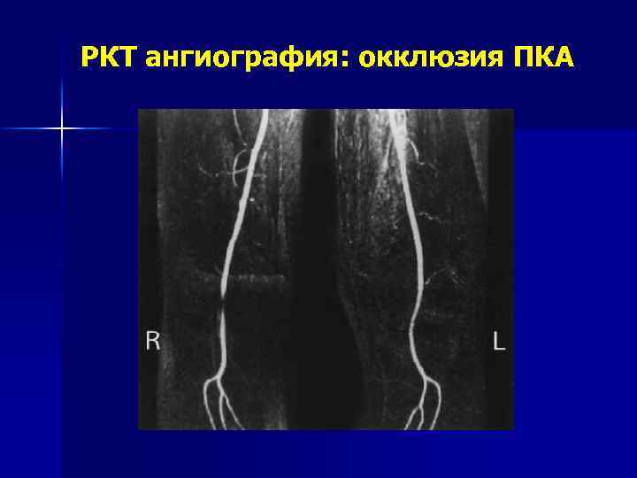 Острая артериальная непроходимость презентация хирургия