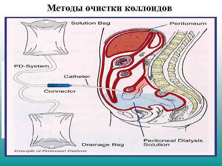 Методы очистки коллоидов Диализ - освобождение коллоидных растворов от примесей, способных проникать через растительные,