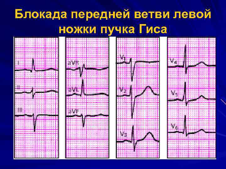 Картинки полная блокада левой ножки пучка гиса