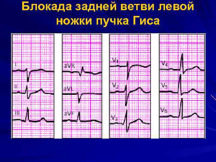 Блокада задней ветви левой ножки пучка Гиса 