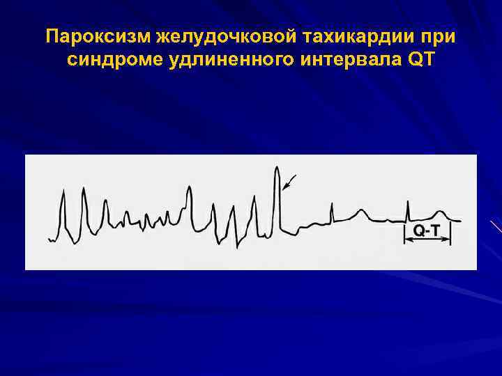 Пароксизм желудочковой тахикардии при синдроме удлиненного интервала QT 
