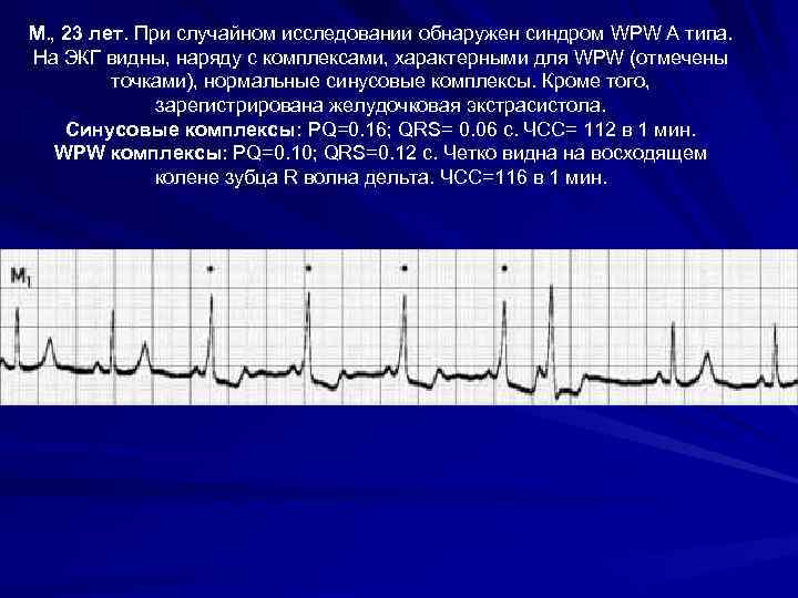 М. , 23 лет. При случайном исследовании обнаружен синдром WPW А типа. На ЭКГ