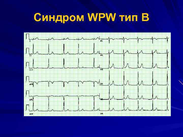 Wpw на экг фото