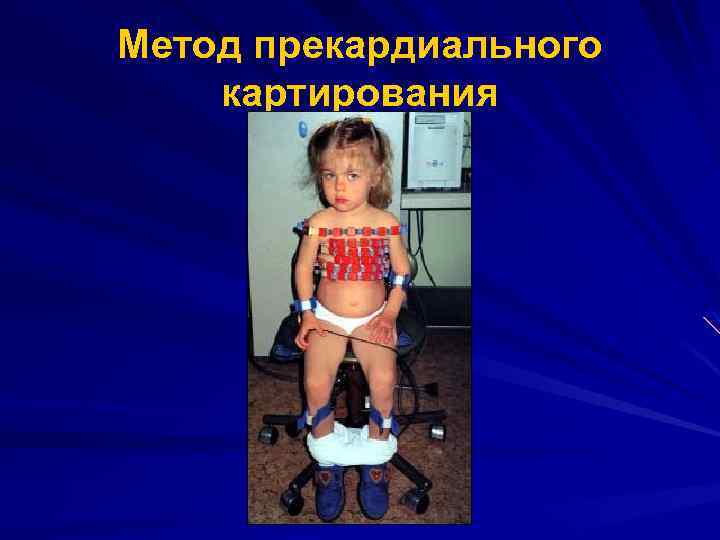 Метод прекардиального картирования 