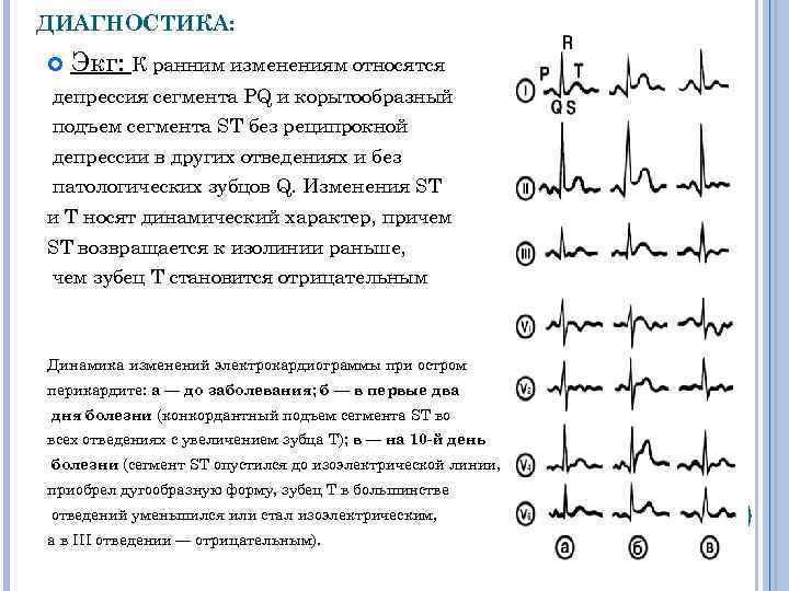 Перикардит экг картина