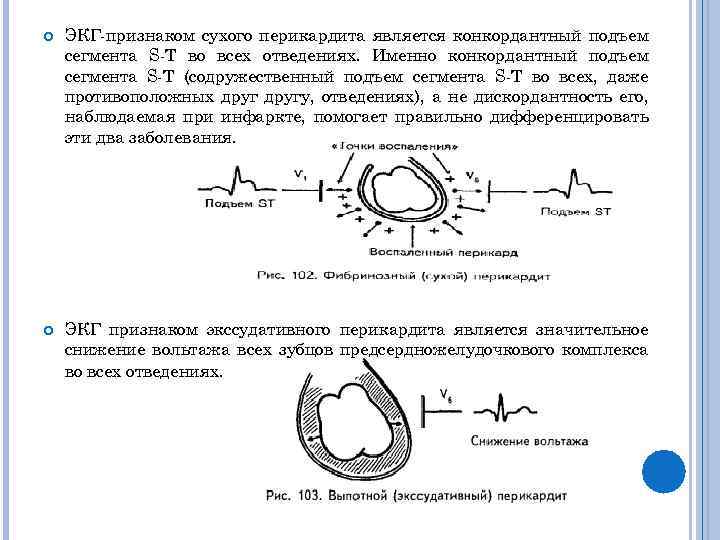 Перикардит экг картина