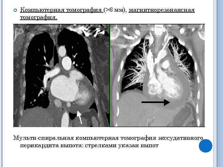 Выпотной перикардит. Экссудативный перикардит мрт. Перикардит компьютерная томография.