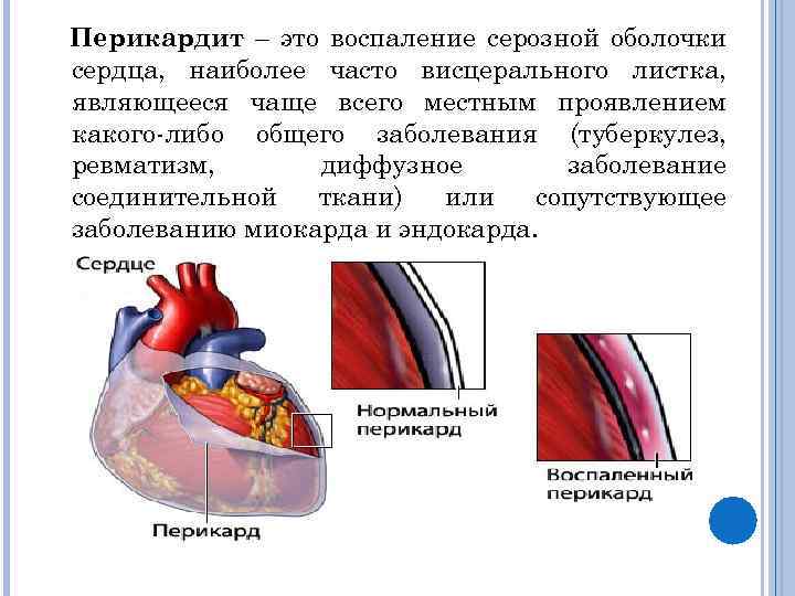 Перикард что это простыми словами