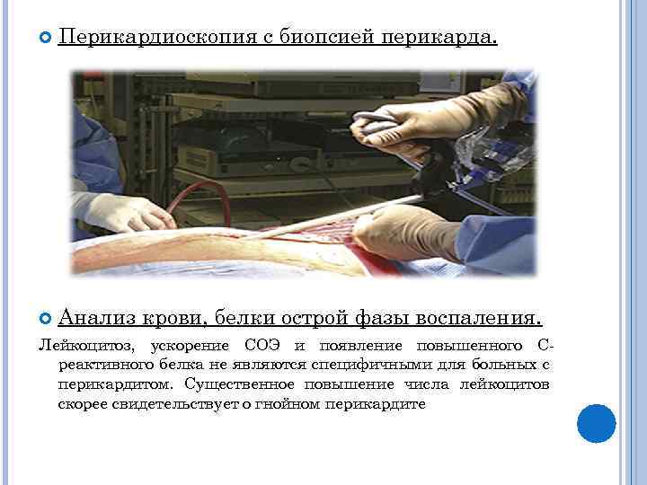  Перикардиоскопия с биопсией перикарда. Анализ крови, белки острой фазы воспаления. Лейкоцитоз, ускорение СОЭ