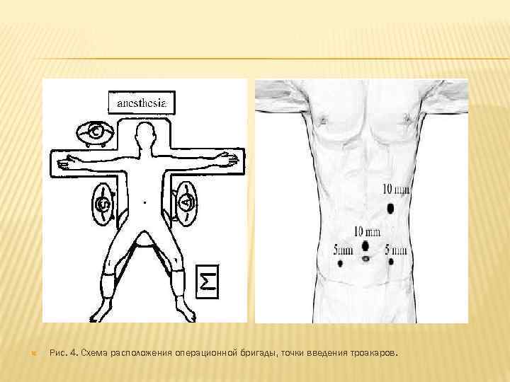   Рис. 4. Схема расположения операционной бригады, точки введения троакаров. 
