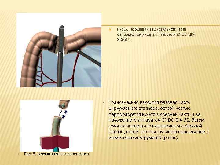     Рис. 5. Прошивание дистальной части    сигмовидной кишки