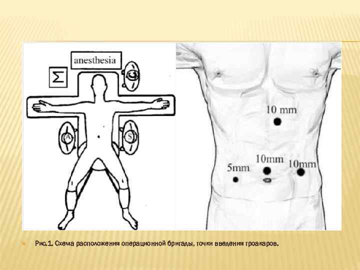   Рис. 1. Схема расположения операционной бригады, точки введения троакаров. 