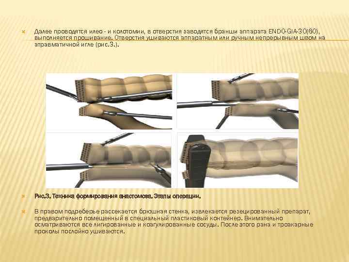   Далее проводятся илео - и колотомии, в отверстия заводятся бранши аппарата ENDO-GIA-30(60),