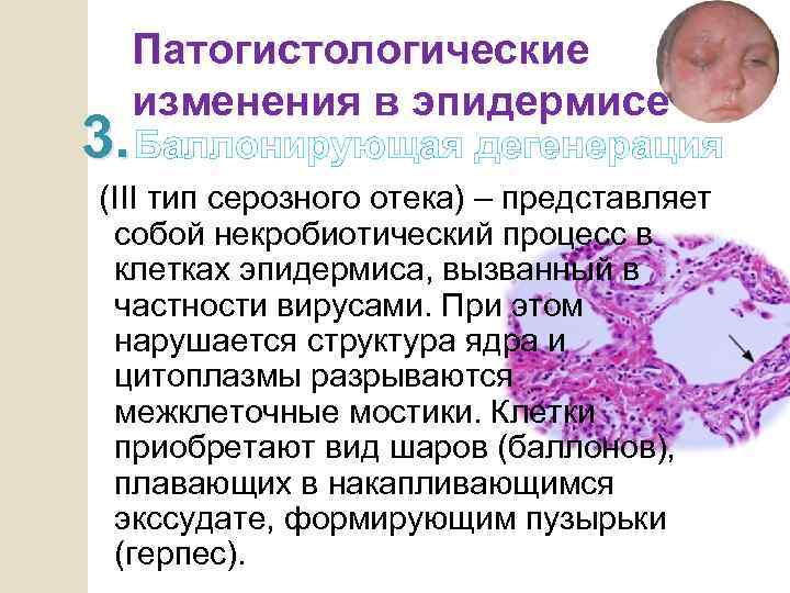 Патогистологические изменения в эпидермисе 3. Баллонирующая дегенерация (III тип серозного отека) – представляет собой