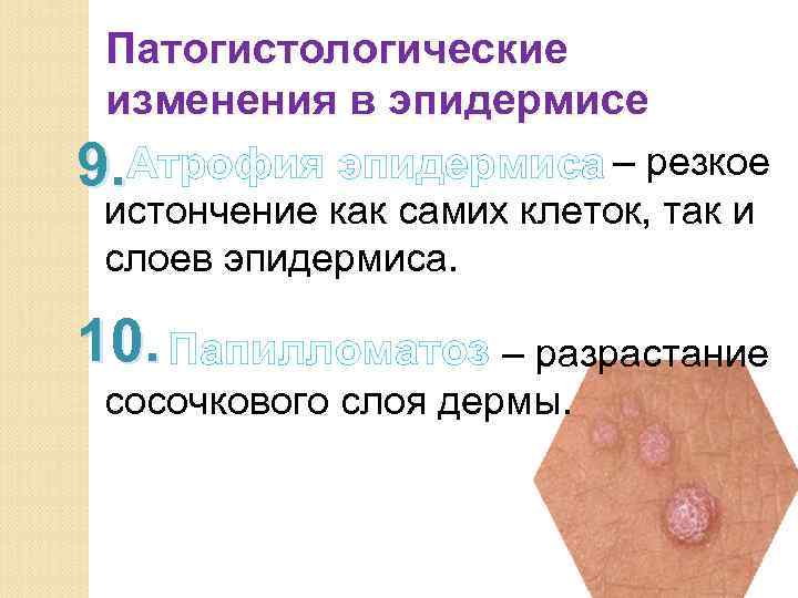 Патогистологические изменения в эпидермисе 9. Атрофия эпидермиса – резкое истончение как самих клеток, так