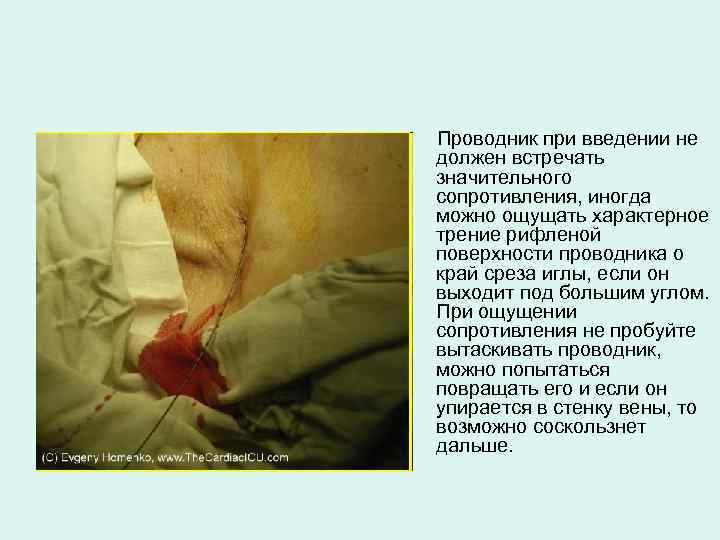 Проводник при введении не должен встречать значительного сопротивления, иногда можно ощущать характерное трение рифленой