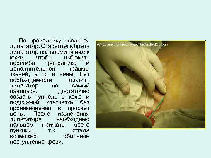 По проводнику вводится дилататор. Старайтесь брать дилататор пальцами ближе к коже, чтобы избежать перегиба