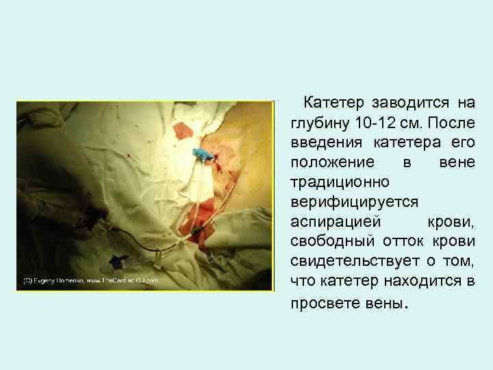 Катетер заводится на глубину 10 -12 см. После введения катетера его положение в вене