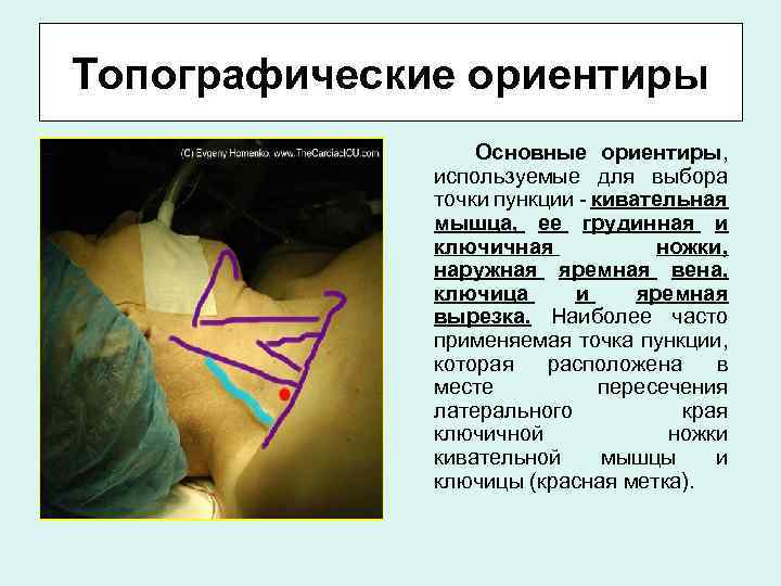 Топографические ориентиры Основные ориентиры, используемые для выбора точки пункции - кивательная мышца, ее грудинная