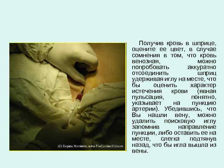 Получив кровь в шприце, оцените ее цвет, в случае сомнения в том, что кровь