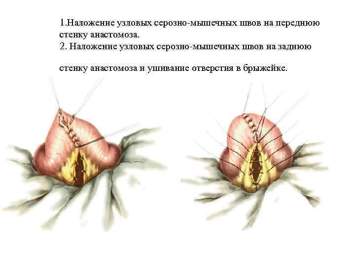 1. Наложение узловых серозно-мышечных швов на переднюю стенку анастомоза. 2. Наложение узловых серозно-мышечных швов