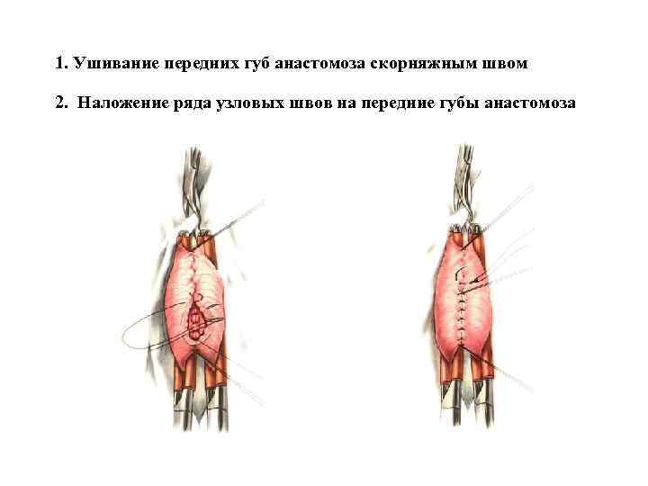 1. Ушивание передних губ анастомоза скорняжным швом 2. Наложение ряда узловых швов на передние